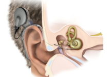 Nocera Inferiore: all’UOC dell’ospedale nocerino, doppio intervento di impianto cocleare